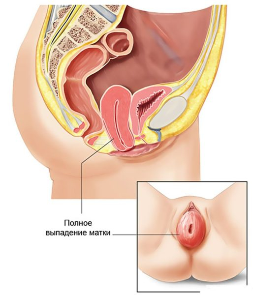 Выпадение матки