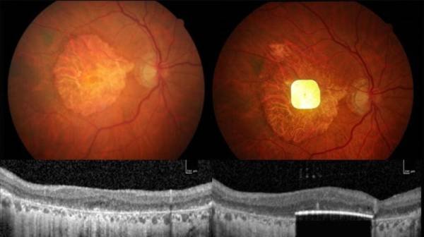 Aging: Eye implant restores vision loss from irreversible condition