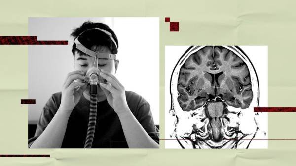Could treating obstructive sleep apnea lower stroke or dementia risk?